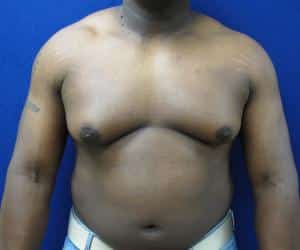 Male Breast Reduction - Before