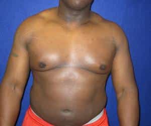 Case--1596 | After Liposuction