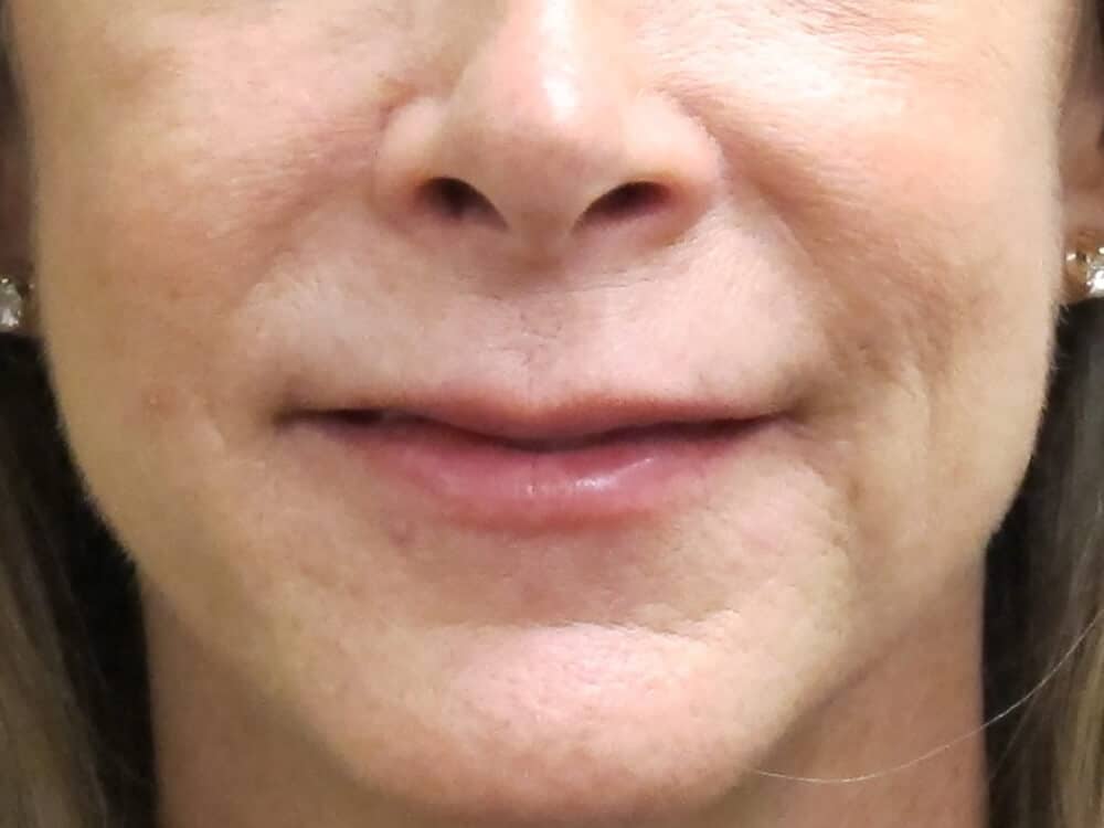 Case--4796 | Before Injectables