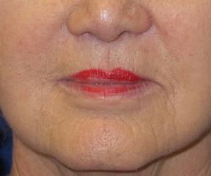 Case--6038 | After Injectables