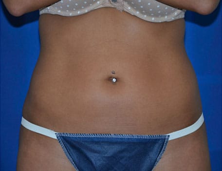 Case--3034 | After Liposonix