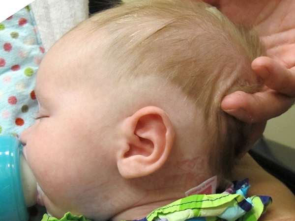 Case--9898 | After EarWell™