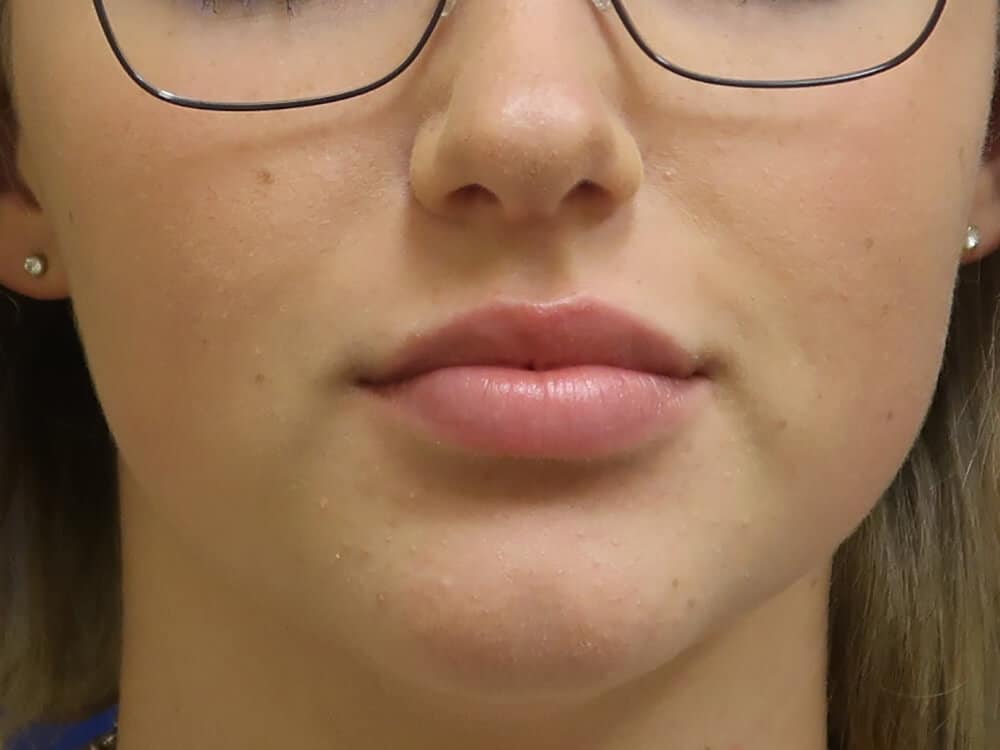 Case--2533 | After Injectables