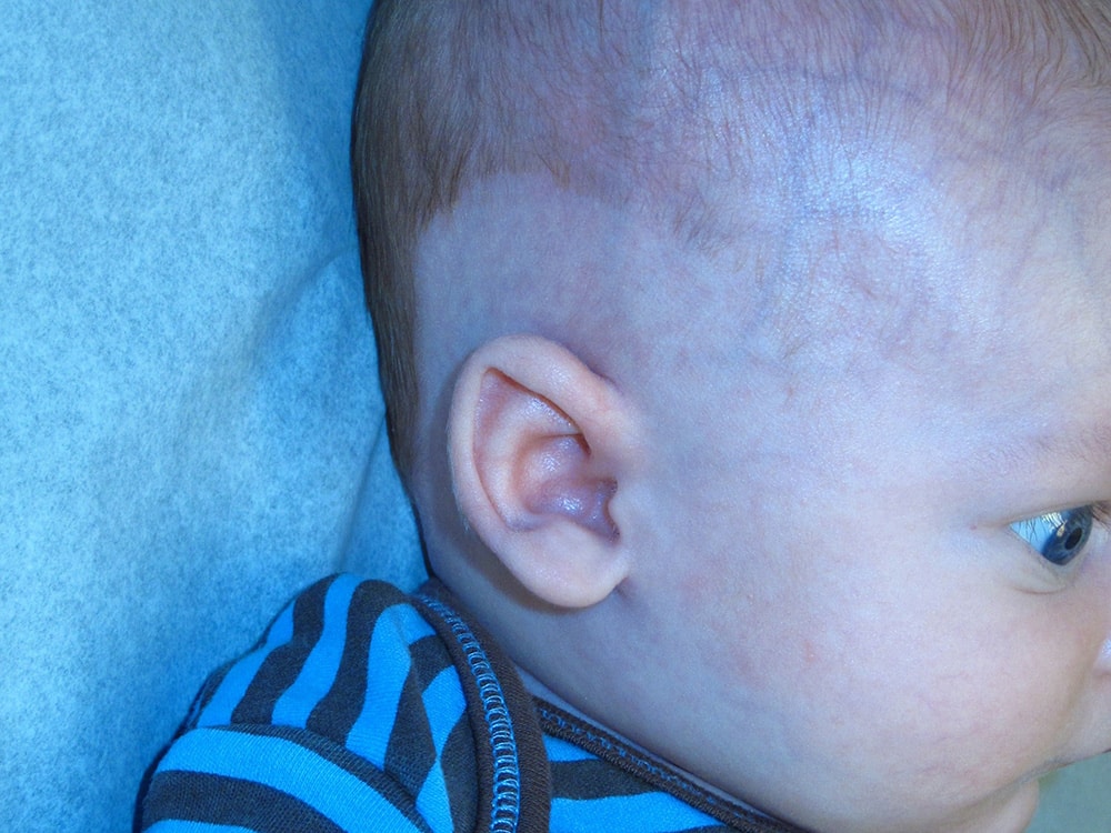 Case--6207 | After EarWell™