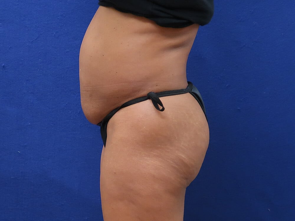 Case--7850 | Before Tummy Tuck