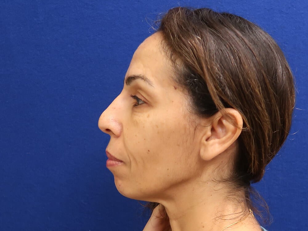 Case--6912 | After Injectables