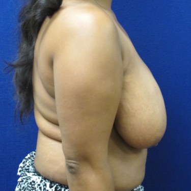 Breast Reduction - Before