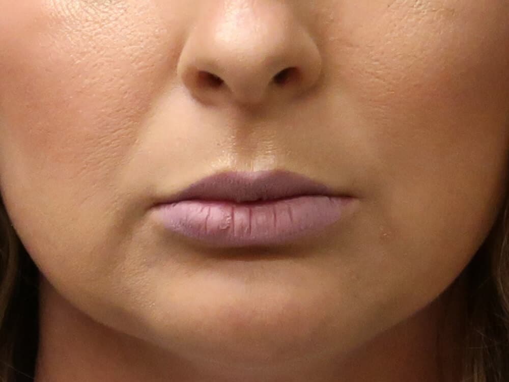 Case--8247 | After Fat Grafting