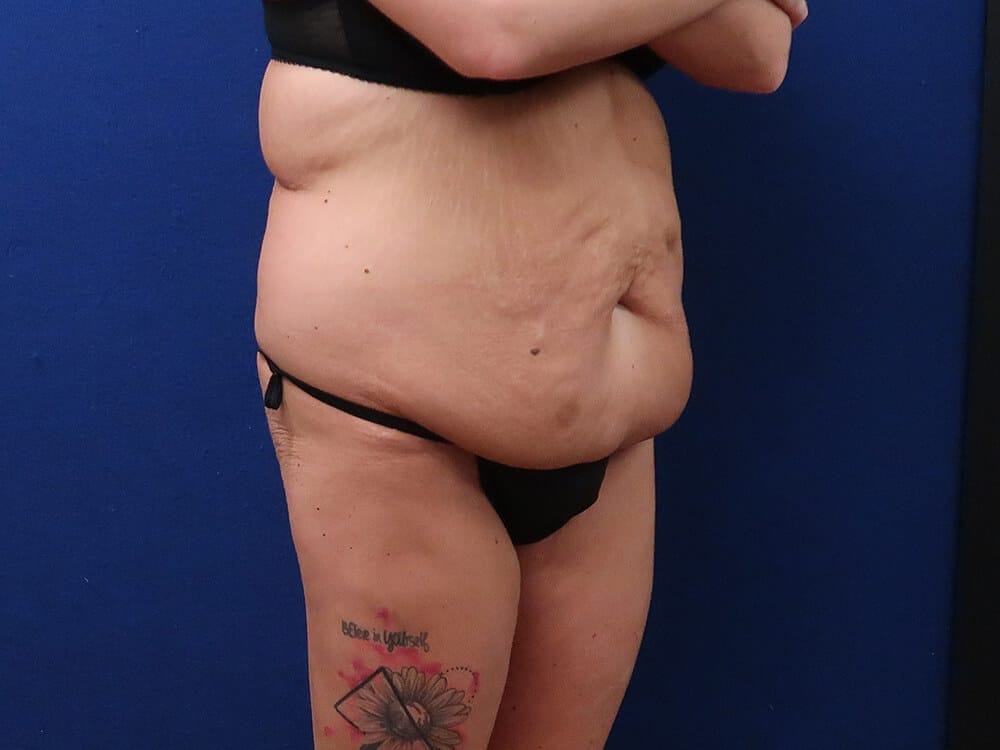 Case--1536 | Before Lower Body Lift