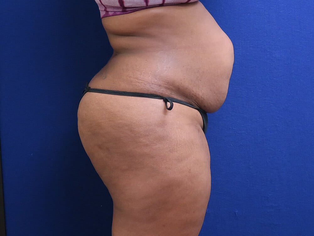 Case--4576 | Before Tummy Tuck