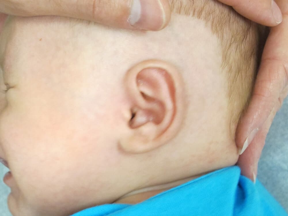 Case--7712 | After EarWell™