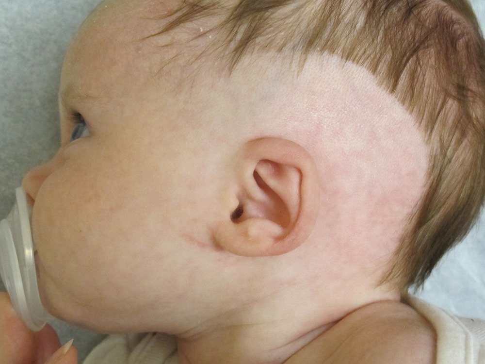 Case--8045 | After EarWell™