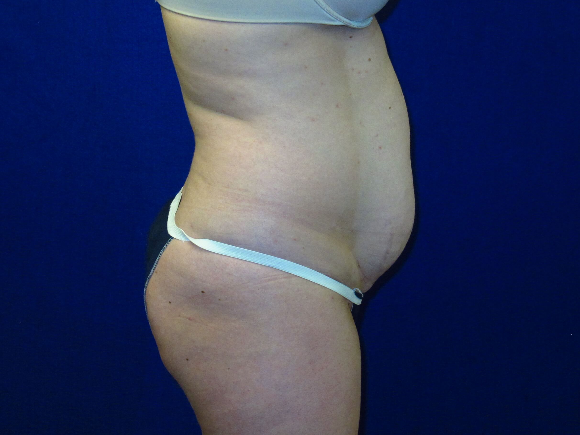 Case--1958 | Before Tummy Tuck