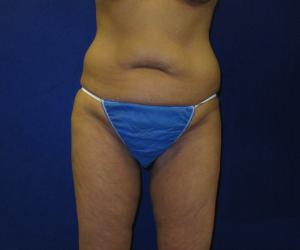 Case--3174 | Before Thigh Lift