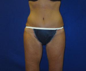 Case--3174 | After Thigh Lift