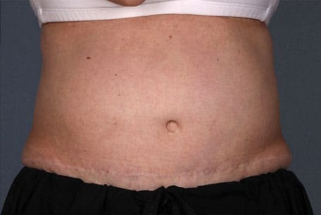 Case--1437 | Before Liposonix