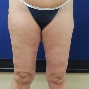Thigh Lift - After