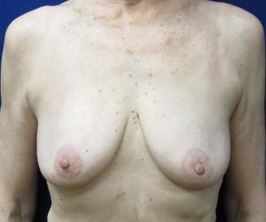 Breast Augmentation - Before