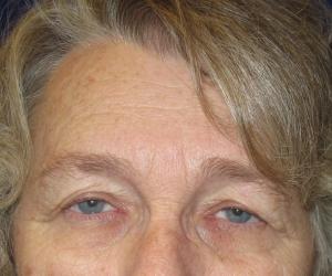 Case--2686 | Before Brow Lift