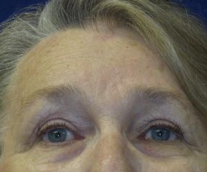 Case--2686 | After Brow Lift