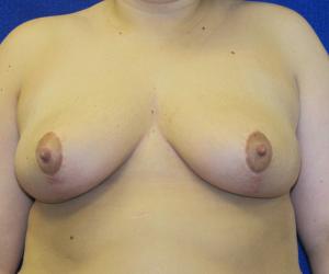 Breast Reduction- After