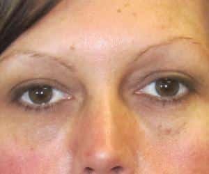 Case--5631 | After Injectables