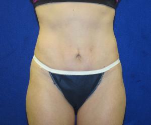 Case--8426 | After Tummy Tuck