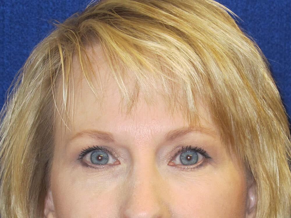 Case--9625 | After Injectables