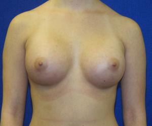 Breast Augmentation - After