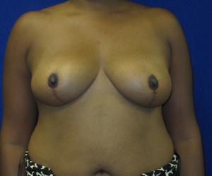 Breast Reduction- After