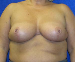 Breast Reduction- After