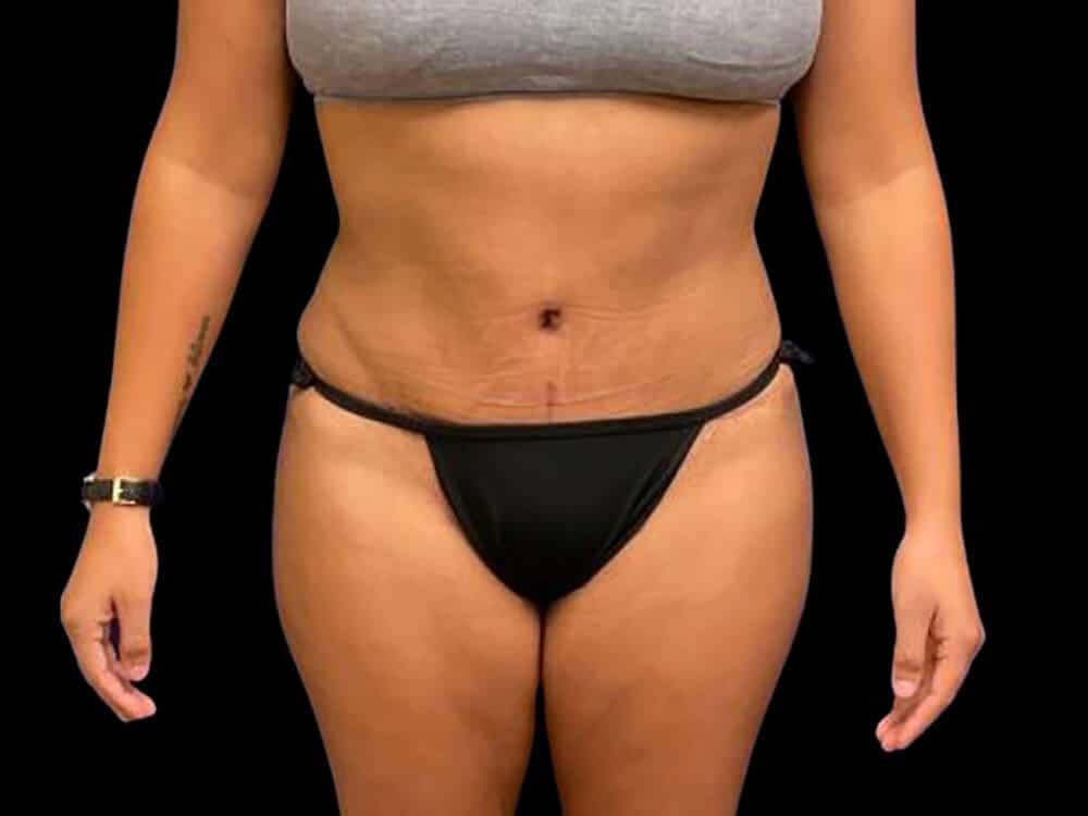 Case--1112 | After Body