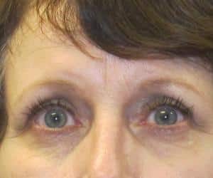 Case--6209 | After Blepharoplasty