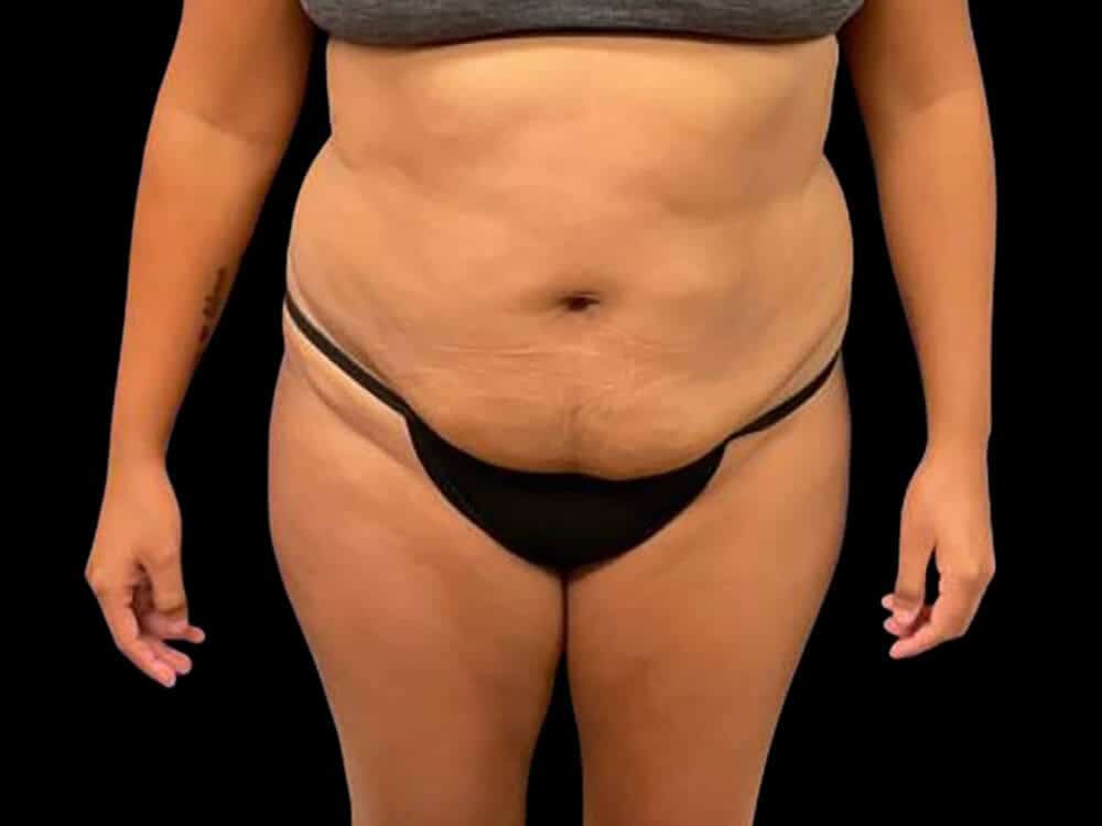 Case--1112 | Before Body