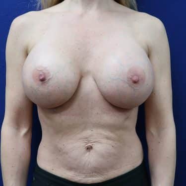 Breast Revision - After
