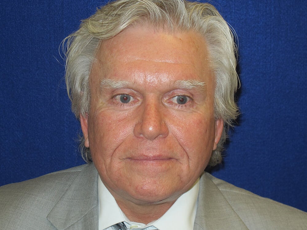 Case--7676 | After Facelift