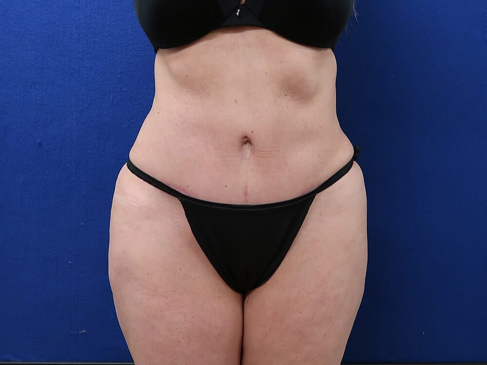Case--5083 | After Tummy Tuck