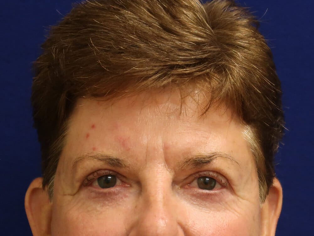 Case--1583 | After Blepharoplasty