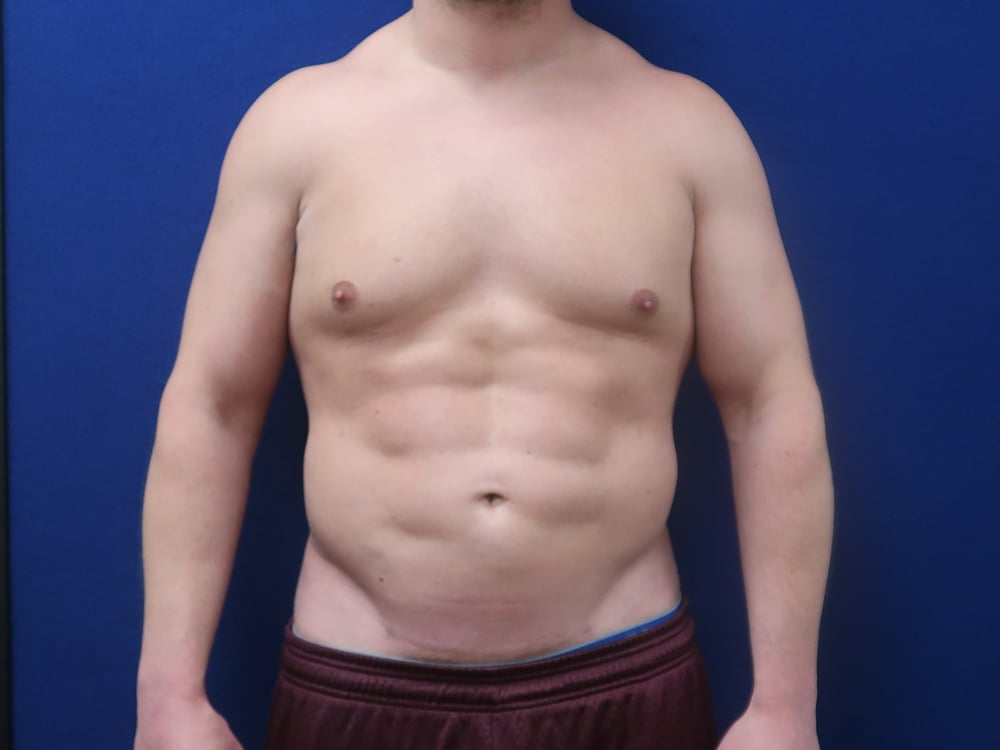 Case--1628 | After High Definition Liposuction