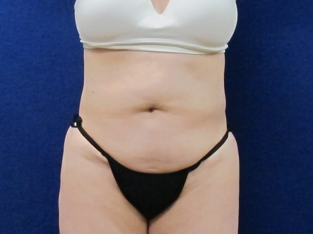 Case--5359 | After Liposuction