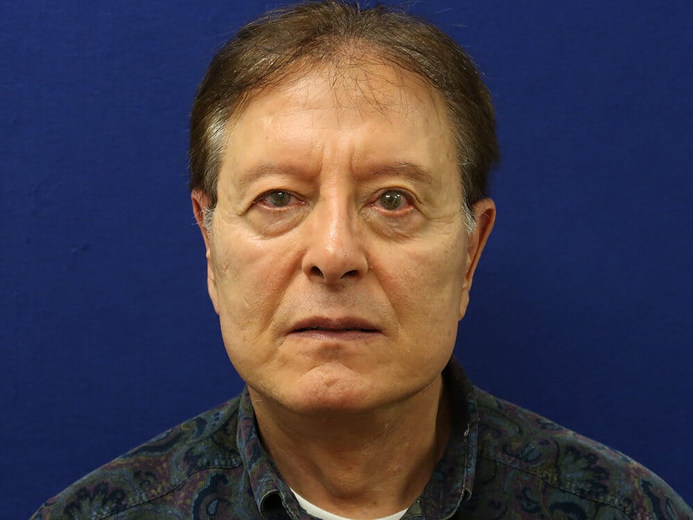 Case--1963 | After Facelift