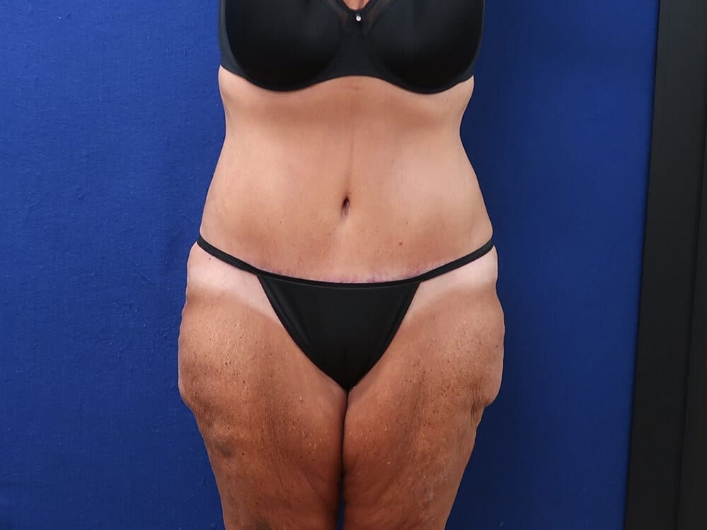 Case--7151 | After Body