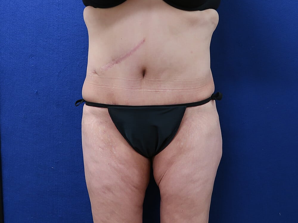 Case--9062 | After Tummy Tuck