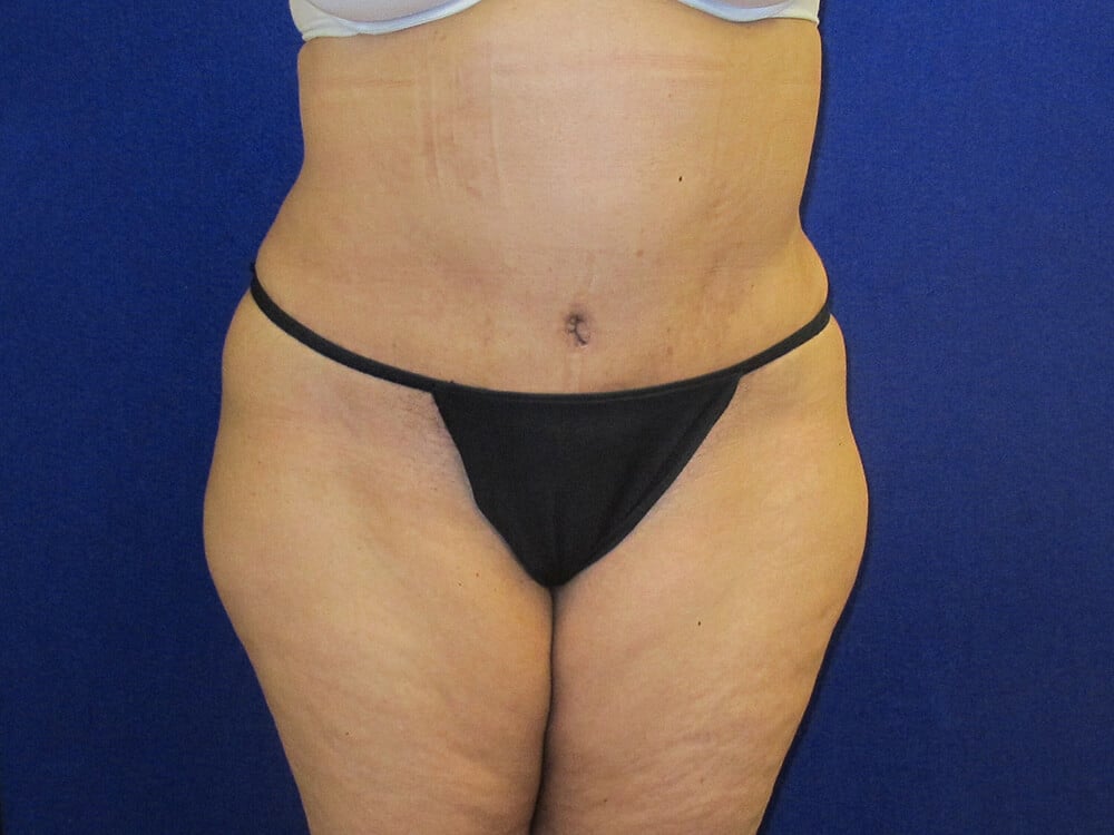 Case--4955 | After Tummy Tuck