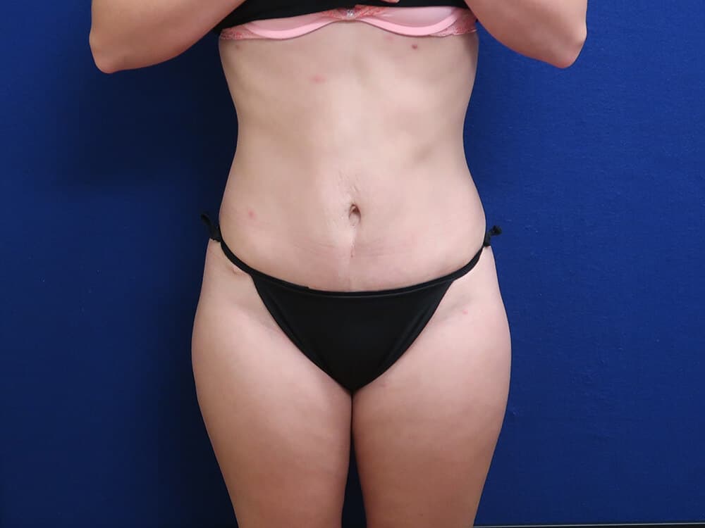 Case--7395 | After Body