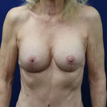 Breast Revision - After