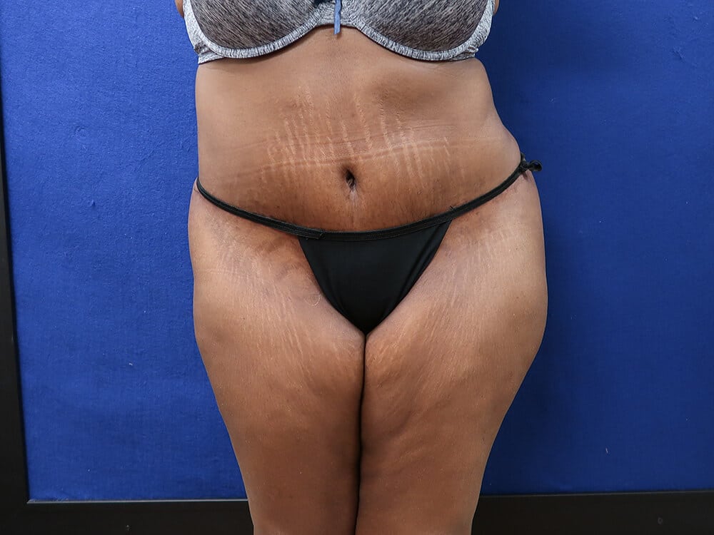 Case--8638 | After Tummy Tuck