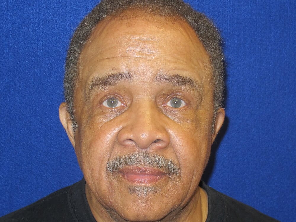 Case--9786 | After Blepharoplasty