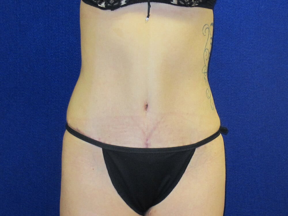 Case--5481 | After Tummy Tuck