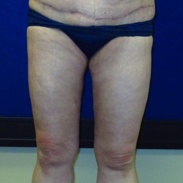 Thigh Lift -After